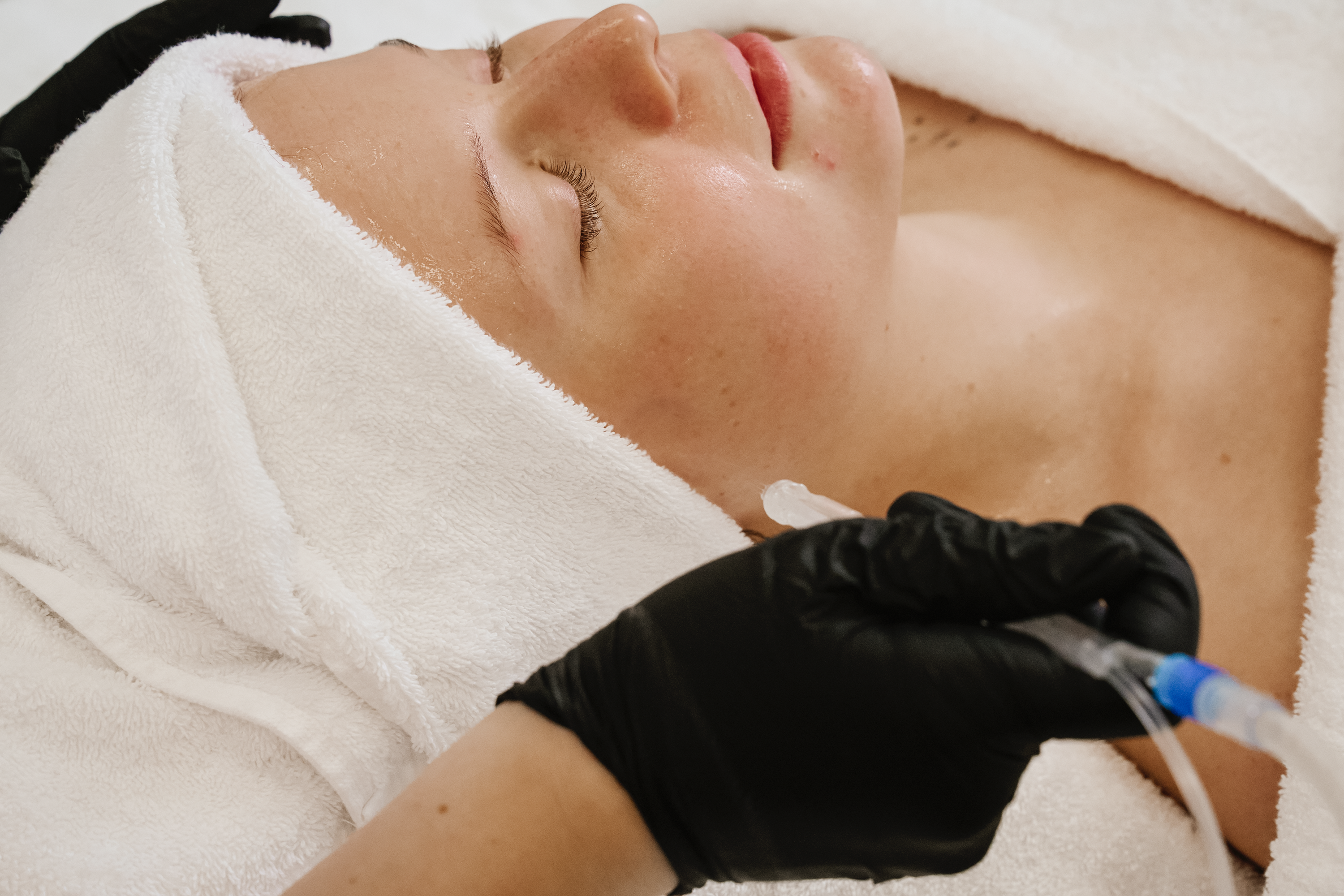 jetpeel-behandlungsablauf-muenchen