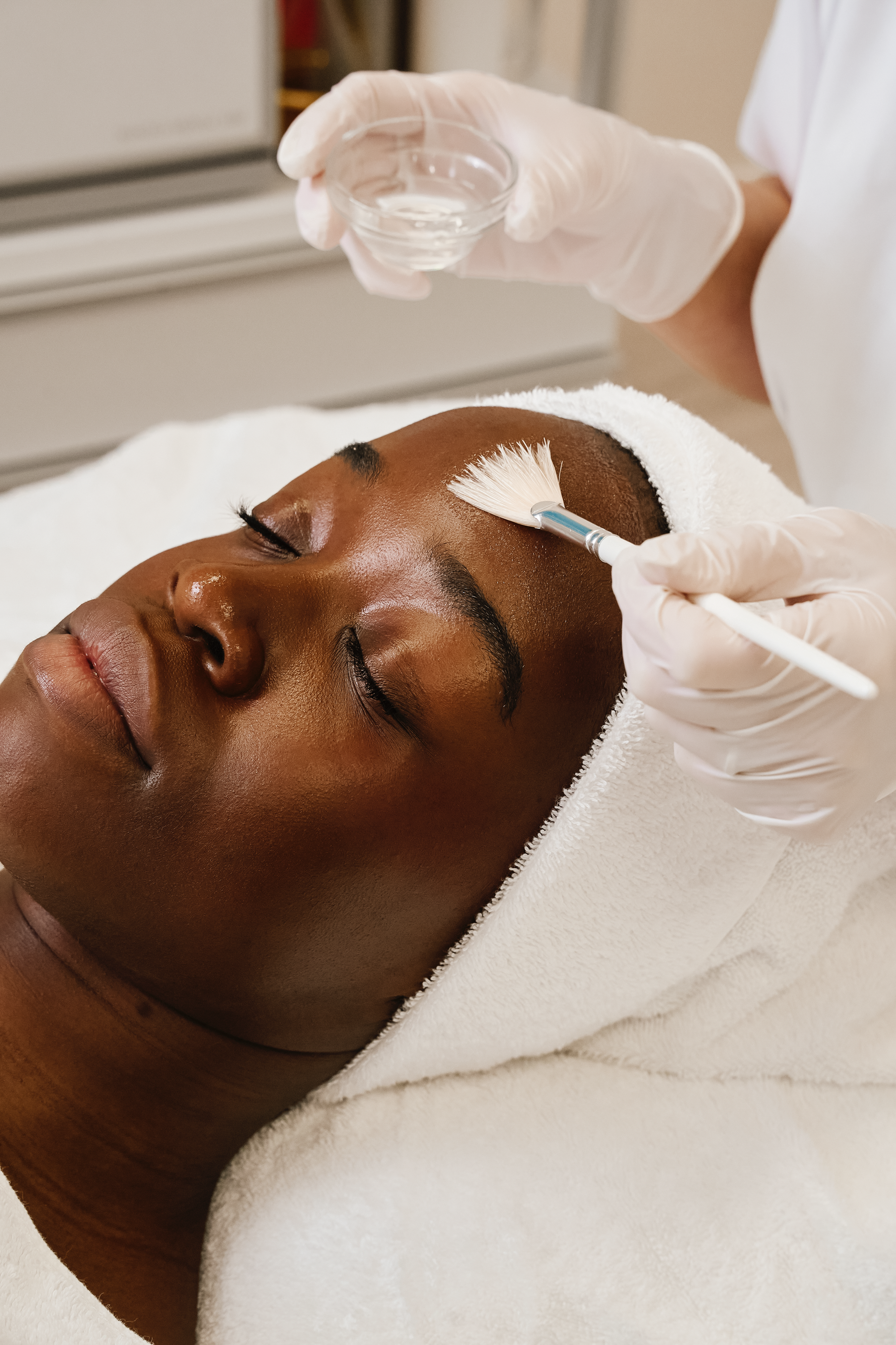 Medizinische Microneedling Gesichtsbehandlung in München